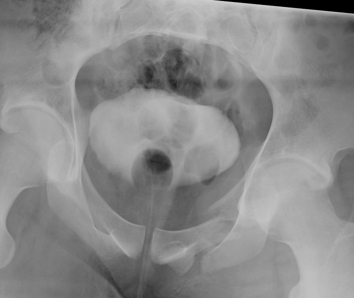 Pelvic Fracture Inlet View